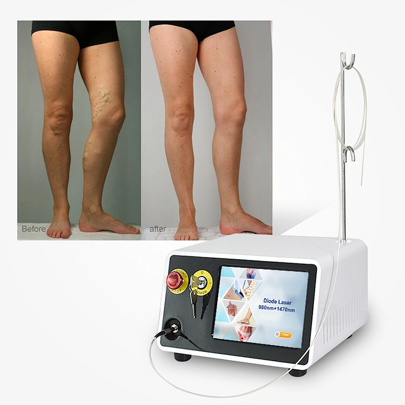 TRIANGEL Laser Fiber For Evlt Treatment 980nm 1470nm Evla Varicose Veins Treatment Machine